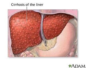 Effect Of Antiviral Therapy On Hepatic Fibrosis