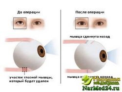 Гимнастика от косоглазия Гимнастика от косоглазия