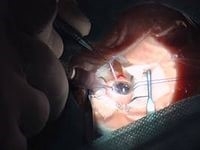 Хирургическое лечение близорукости Хирургическое лечение близорукости