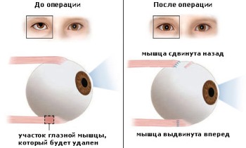 Паретическое косоглазие Паретическое косоглазие