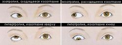 Расходящееся косоглазие причины Расходящееся косоглазие причины