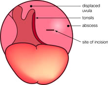 Some Important Facts about Peritonsillar Abscess