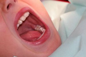 Few Interesting Facts About Peritonsillar Abscess