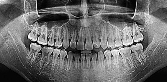 томография зубов