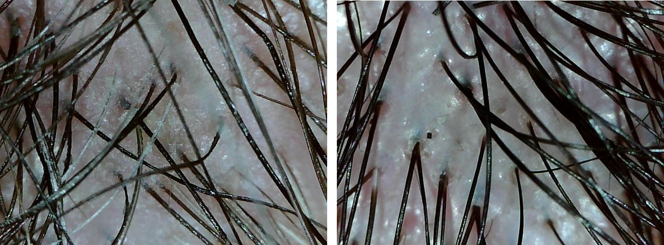 Волосы после бритья под микроскопом